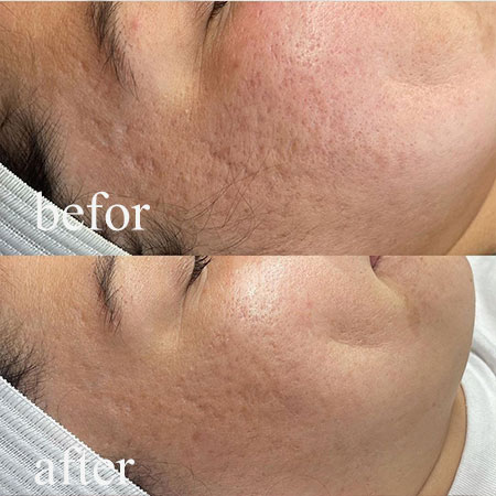 Microdermabrasie1