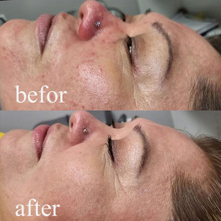 Microneedeling-Met-cocktail