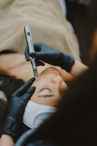 microneedeling 