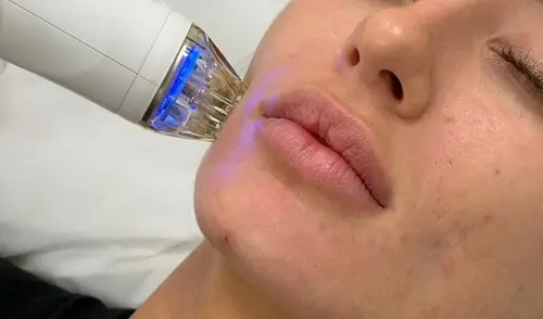 microneedling jawline