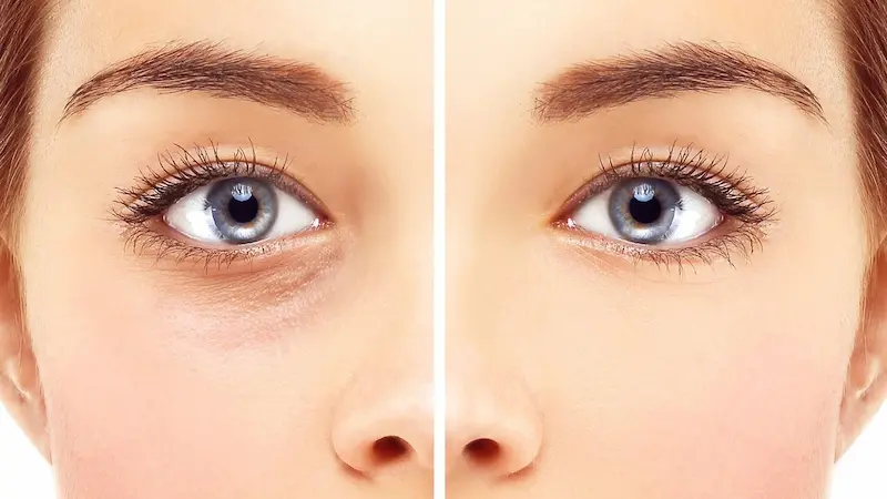 Microneedling Onder de Ogen