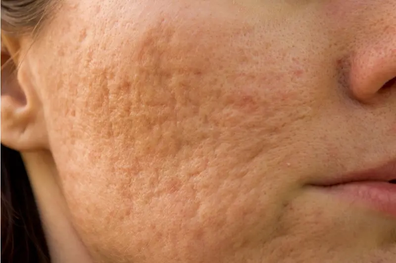 microneedling littekens