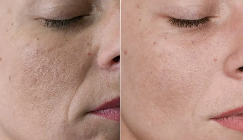 microneedling littekens