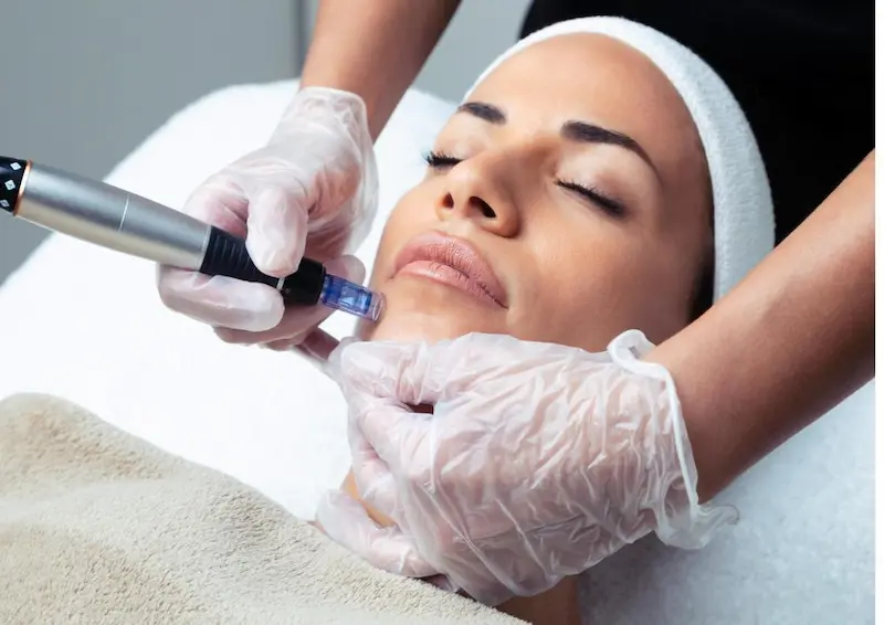 voor en nadelen van microneedling